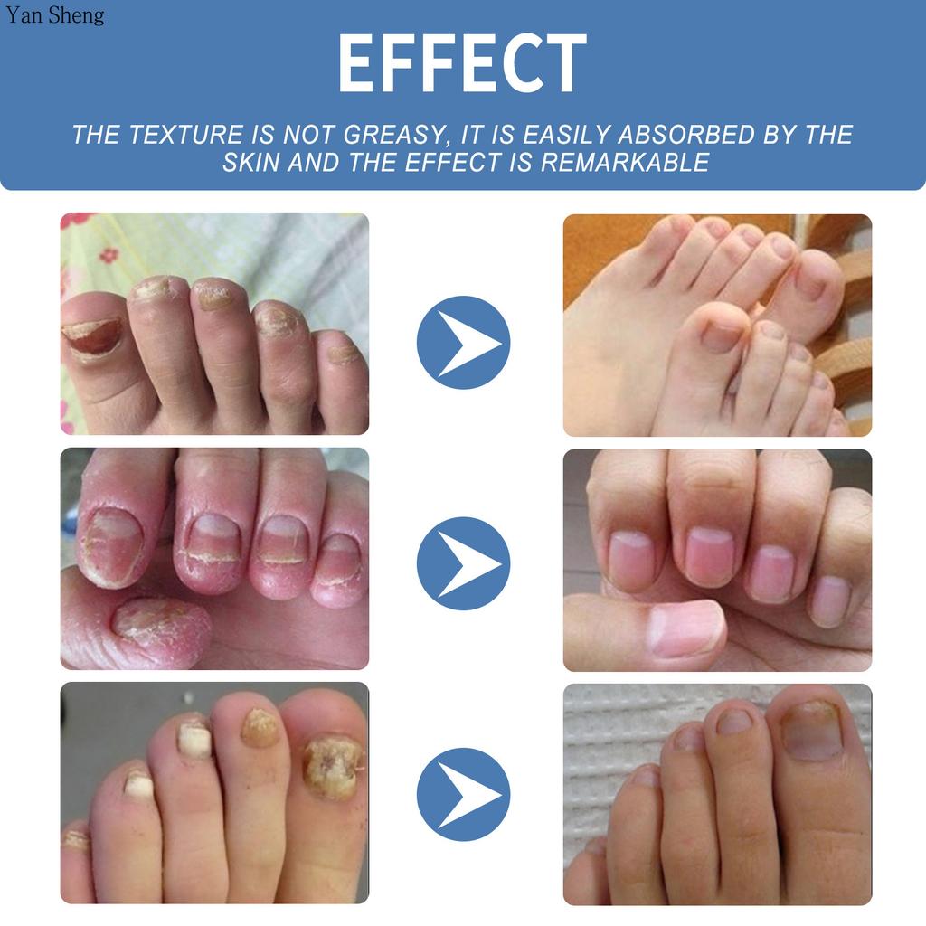Nail Care Gel Hand Foot Onychomycosis Soft Nail Thickening Nail Luminescent Nail Repair Gel
