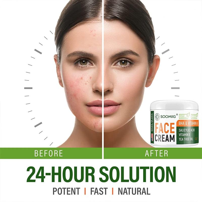 

Удаление шрамов от акне и удаление капсул для пластырей акне - уход за предотвращением высыпаний для нормальной, сухой и жирной кожи