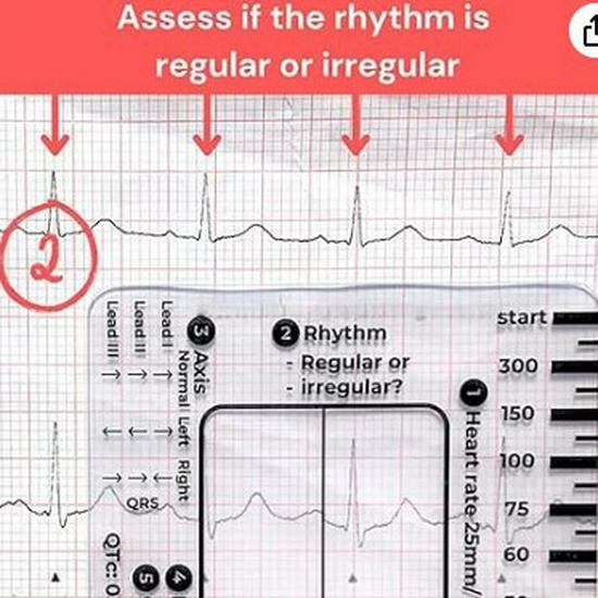 7-Step ECG Interpretation Ruler: Transparent Caliper Tool