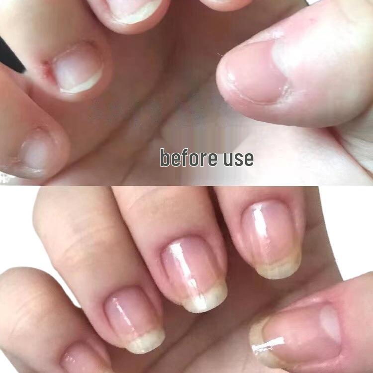Silikon Anti-Beiß-Fingerlinge für Kinder - Rutschfeste Nagelschützer