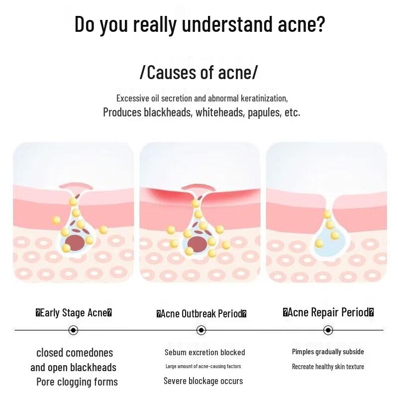 Winona Acne Clearing Cream