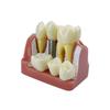 Modello Dimostrativo di Impianti Dentali 4 Volte Denti Analisi Impianti Corona Ponte Modello Rimovibile Per Studenti Dentisti Insegnamento Studio