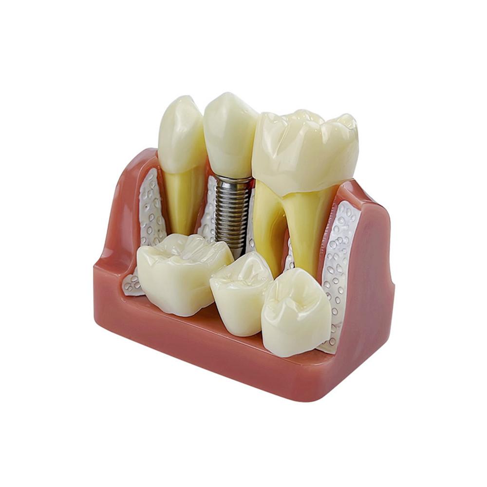 Modello Dimostrativo di Impianti Dentali 4 Volte Denti Analisi Impianti Corona Ponte Modello Rimovibile Per Studenti Dentisti Insegnamento Studio