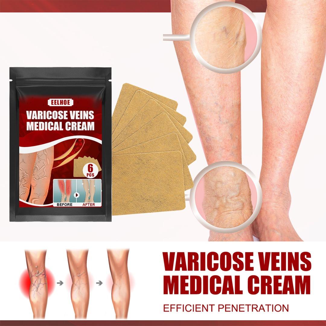 

Tingml 6pcs Varicose Veins Patches Plaster Vasculitis Phlebitis Spider Leg Relief
