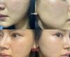 Juvederm Гиалуроновая кислота Массажный ролик для лица Бьюти-инструмент 618
