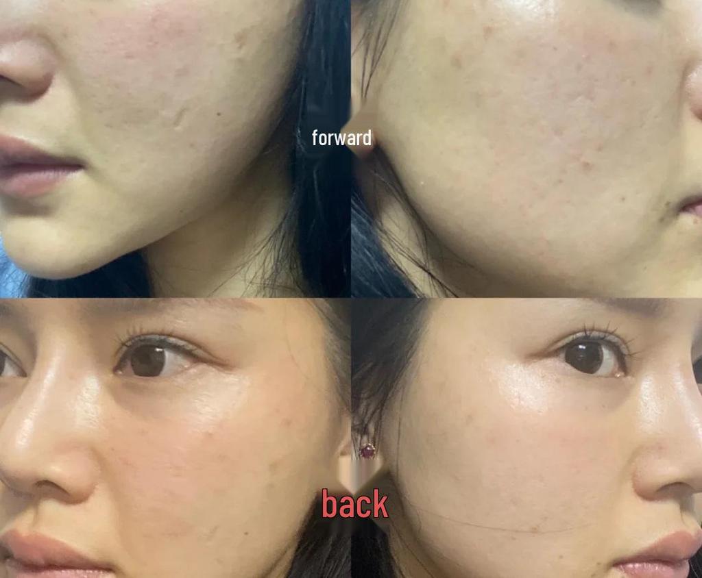 Juvederm Гиалуроновая кислота Массажный ролик для лица Бьюти-инструмент 618