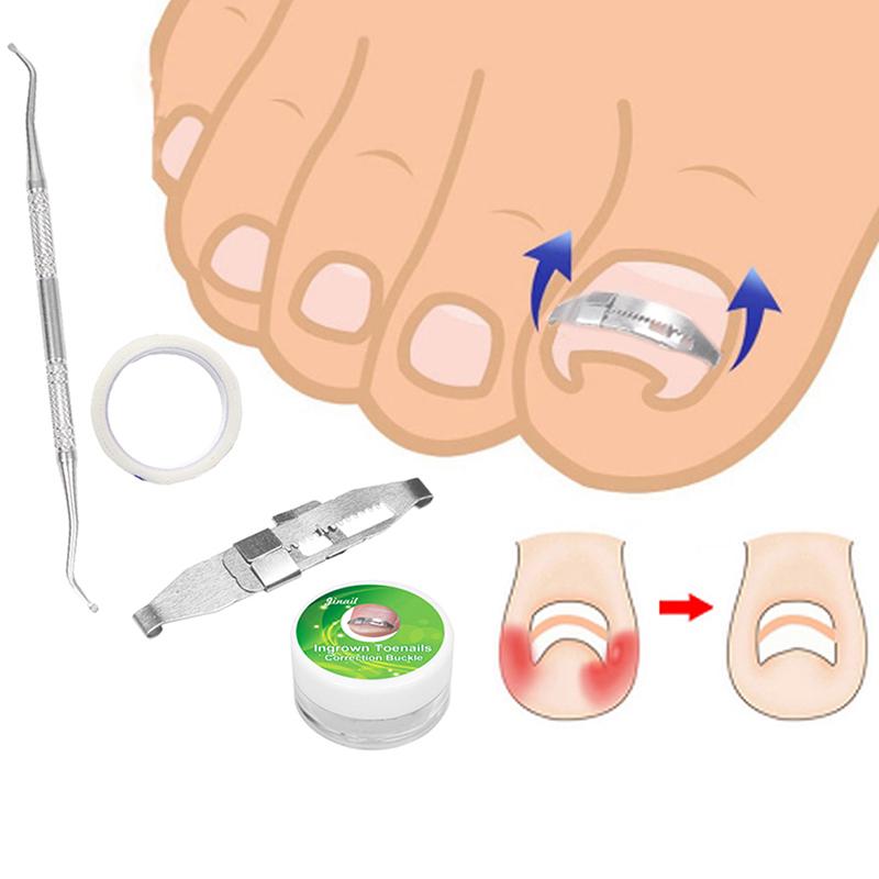 Buy Ingrown Toenail Correction Patch Pedicure Toenail Fixator Foot Care