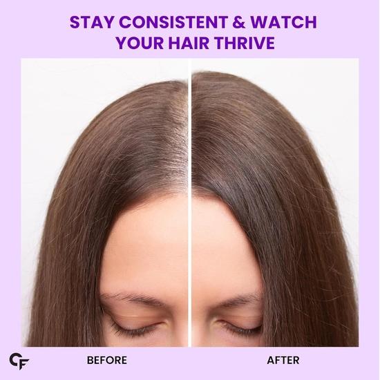 Carbamide Forte Biotintabletter för hårväxt med Amla, Brahmi & Bambuextrakt | Hårväxttablett | Hårvitaminer - 90 Veg Tablett