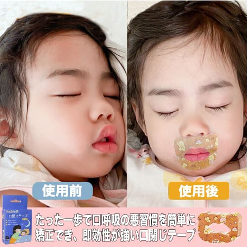 Mouth Closure Tape for Kids, Prevents Mouth Breathing, Helps Prevent Adenoid Face, Prevents Dry Throat, Promotes Nasal Breathing, Improves Sleep, and