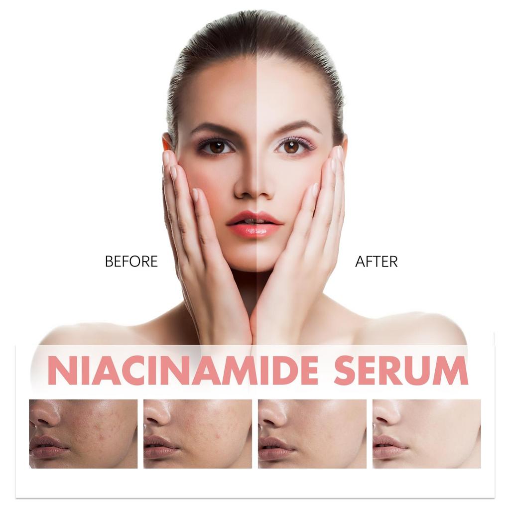 Hoygi Niacinamide Serum Firming & Hydrating Pores Fades Acne Marks & Fine Lines Brightens Skin & Reduces Dark Spots 30ml