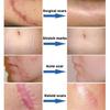 Scar Repair Cream Fade Post-scald Scar Moisturizing Repair Remove Cellulite Scar Cream