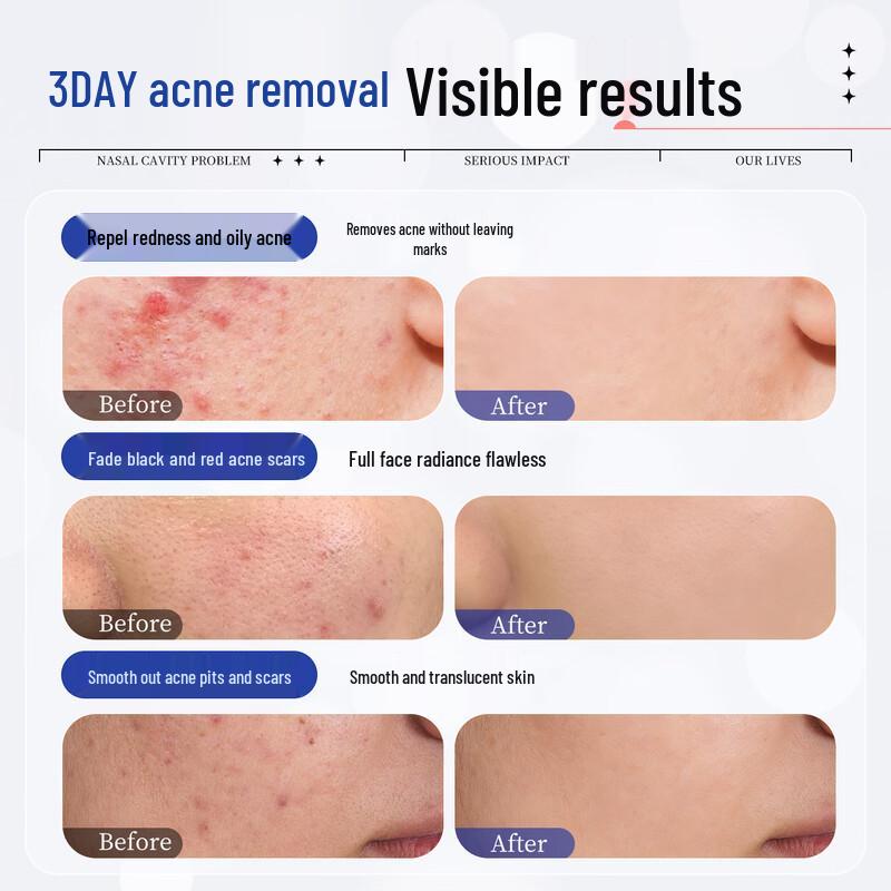 Akasaki Pharma Japan Acne Patches