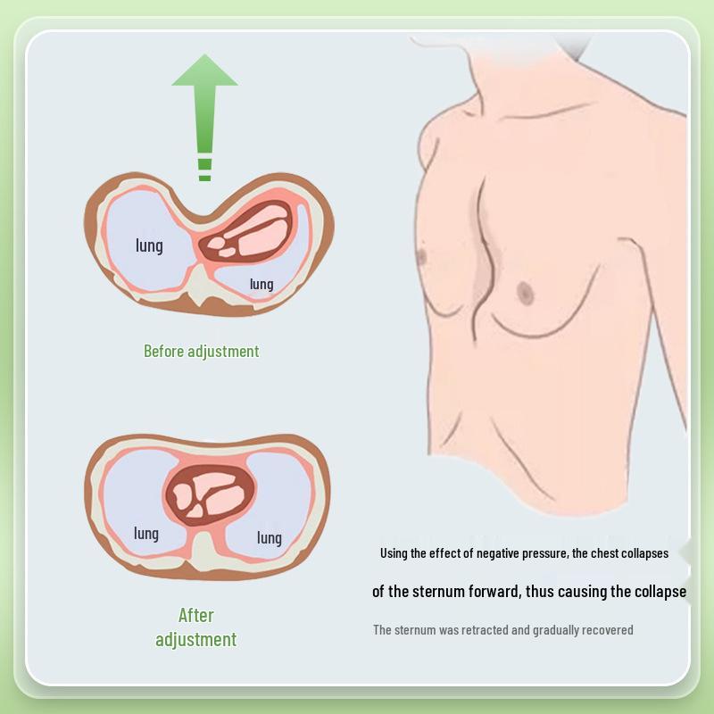 Korektor s přísavkou Pectus Excavatum pro prohlubeň hrudníku