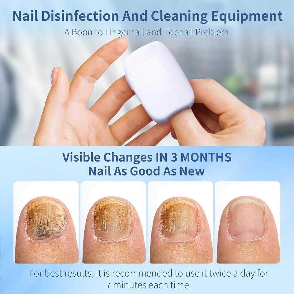Praktische UV-Lampe zur Entfernung von Nagelpilz, Effektives Nagelpilz-Lasergerät, Heimgebrauch