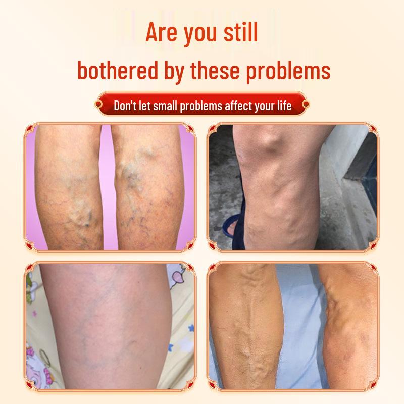 Herbal Varicose Vein Relief Cream for Prominent Veins 20g