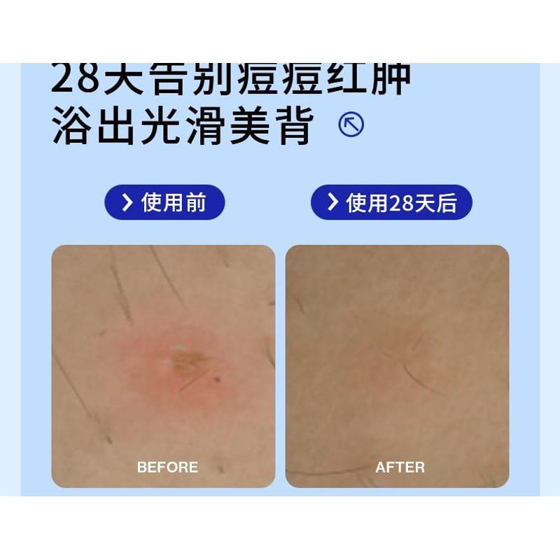 EHD - Bagnoschiuma Detergente Acne Acido Salicilico Profumato