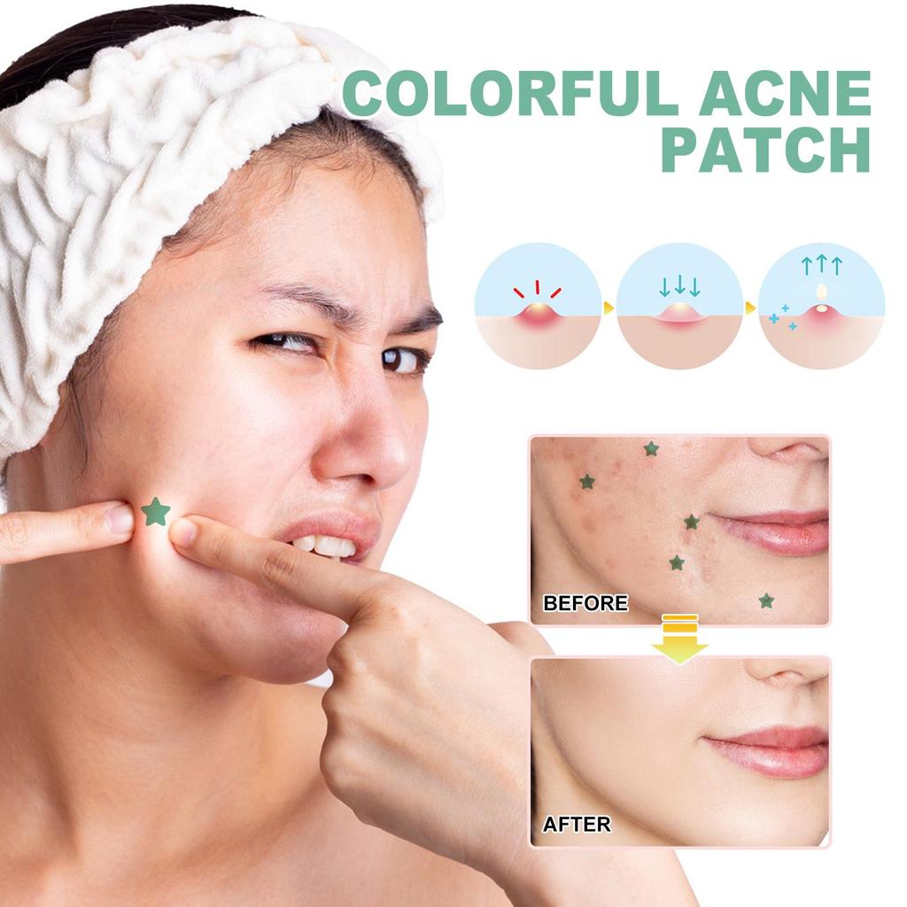 Green Hydrocolloid Acne Patches - Invisible Pimple Spot Treatment, Fast Healing Blemish Covers, Suitable for All Skin Types, 140pcs