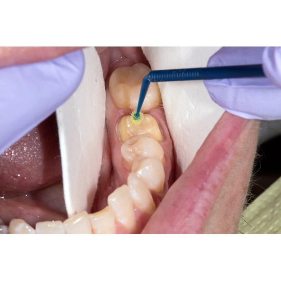 Waldent Silane Primer Syringe