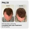 Sons Minoxidil 5% e Derma Roller, 3 Mesi