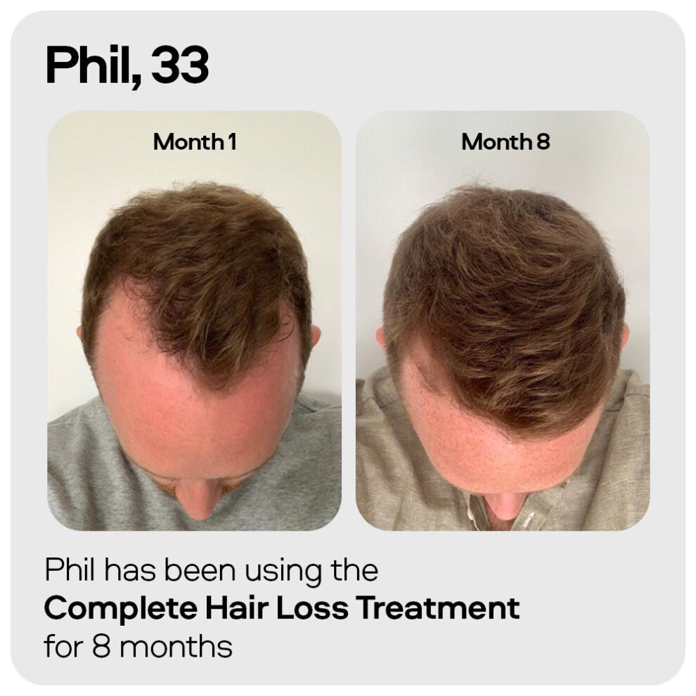 Sons Minoxidil 5% e Derma Roller, 3 Mesi