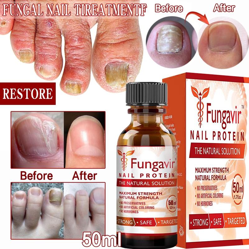 Buy Finger & Toenail Fungus Treatment Removal Feet Care Essence for