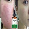 5ML/15ML/30ML/50ML/Anti Redness Solution ,Spider Vein Removal Advanced Treatment Clearer Skin Veins On Face