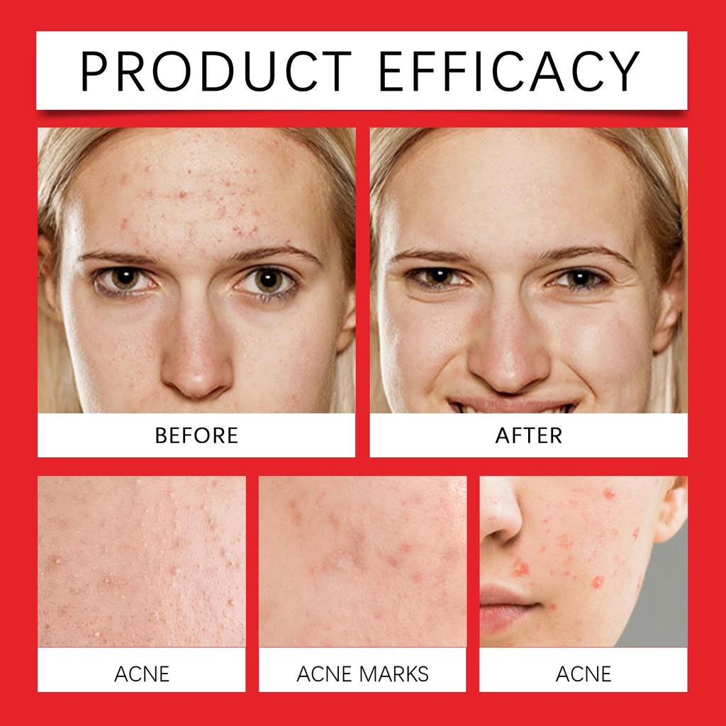 Jaysuing Acne Patches: Top-quality Hydrogel Acne Patches Designed Specifically To Reduce Acne and Whiteheads, 200 Pieces.