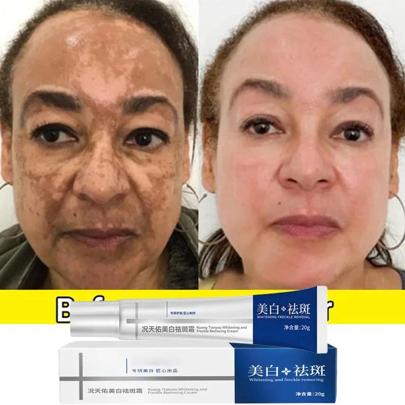 Crème blanchissante efficace pour les taches de rousseur, élimine le mélasma, atténue les taches brunes, hydrate, éclaircit la peau du visage, produit de soin