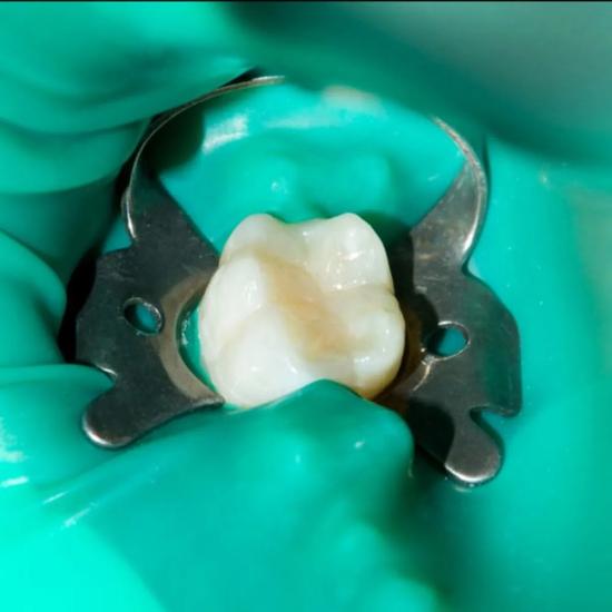 GDC Rubber Dam Clamp Adult 3 (Rdc3)