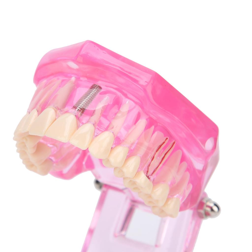 Transparent Adult Teeth Model Pathological Repair Studying Dental Teaching Tools