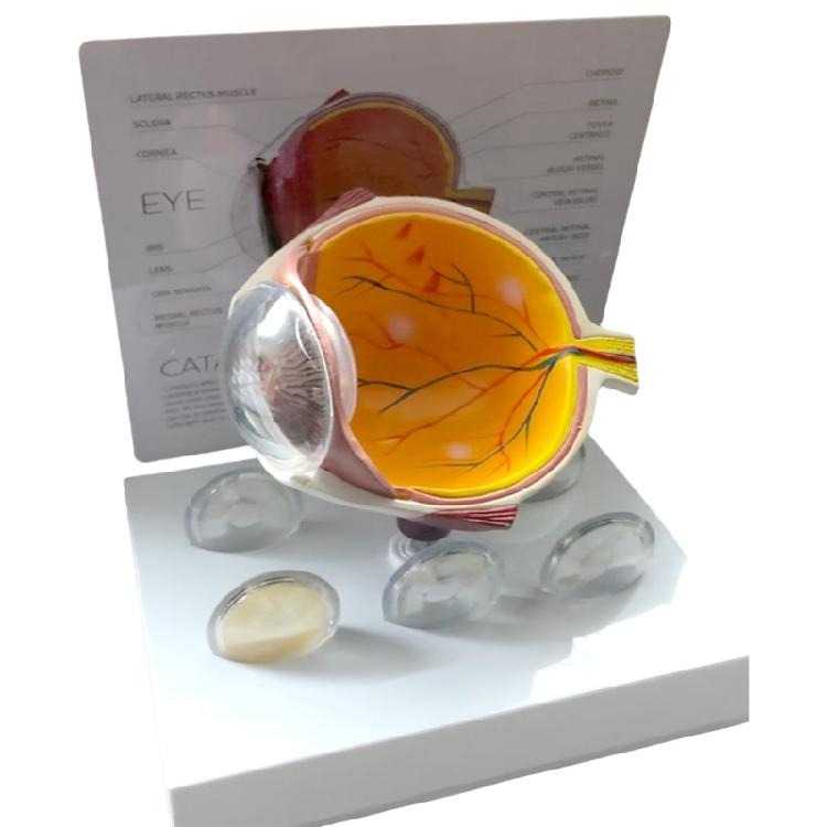 Anatomisch-pathologisches Augapfelmodell, Modell der menschlichen Augapfelanatomie, pathologisches Augapfelanatomiemodell als Lehrmittel