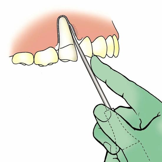 GDC Luxatip - 3mm Curved (L3c)