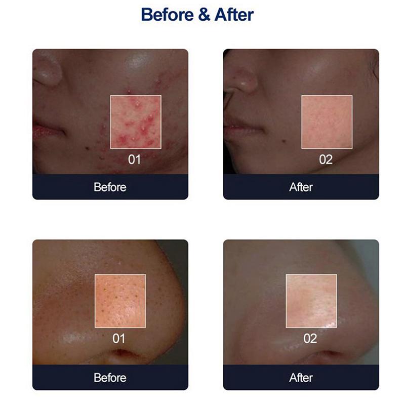 Dermabrasion Tip Diamond Microdermabrasion Dermabrasion Replacement Beauty Tools