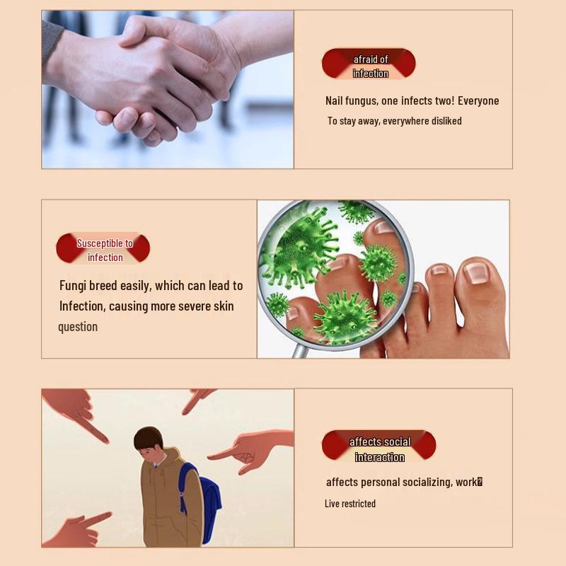 Onychomycosis Relief Lotion: Soothes Discomfort, Reduces Nail Atrophy & Thickening