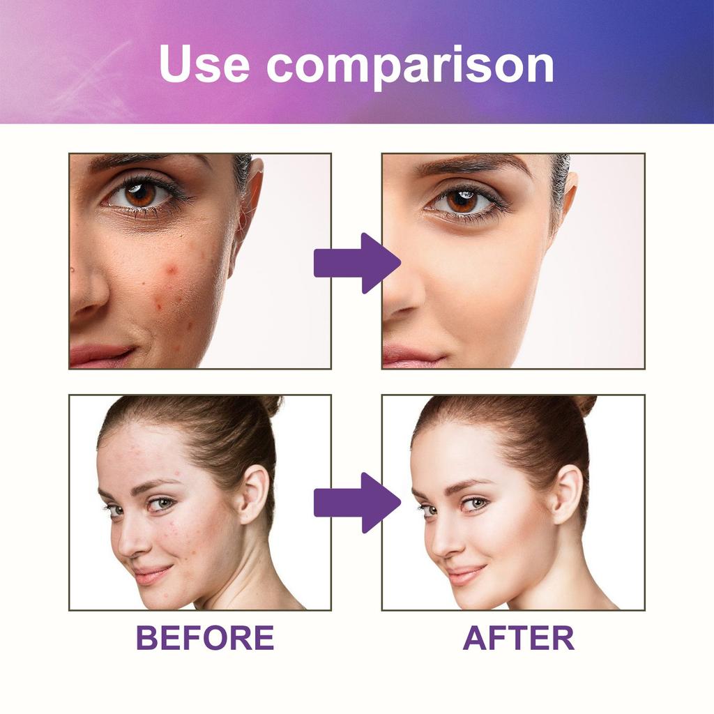 Marine Skin Care Acne Patches For Face, Colorful Pattern Zit Covers,Hydrocolloid Acne Patches With Tea Oil,Green Varec Extract Ect.(144 Count)