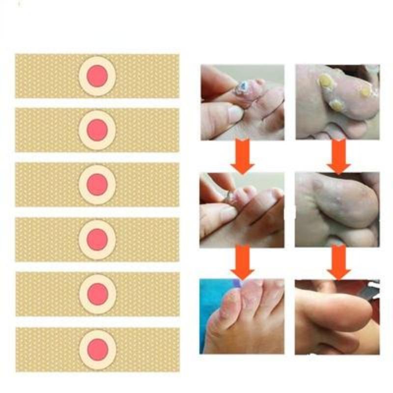 1/36Pcs Foot Corn-Callus Removal Clavus Paster Corn Pads Foot Care Products