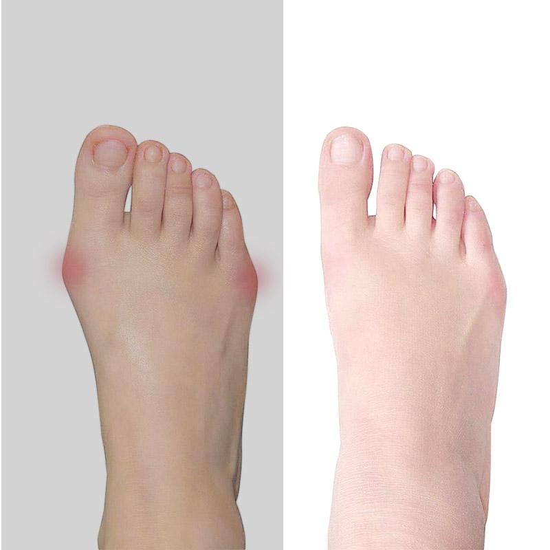 Bunion Corrector Hallux Valgus Splint Gel Bunion Orthopedic Pads Sleeves Brace Toe Stretcher for Overlapping Toes
