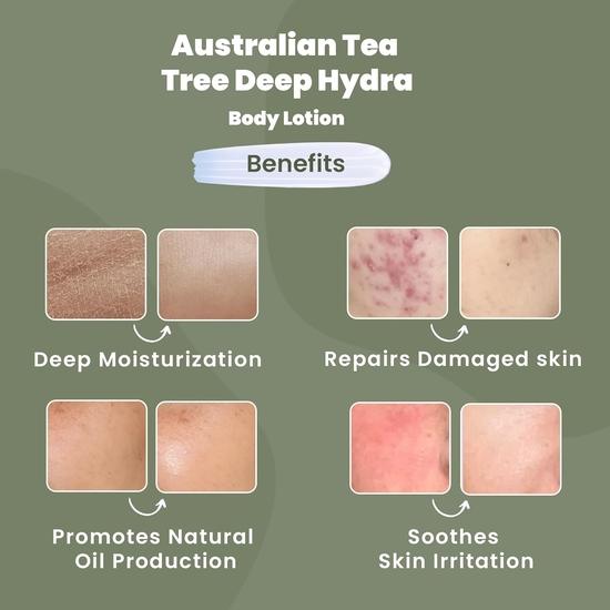 WildOak Super Hydrating Body Lotion | 4X Niacinamide, Shea Butter | Soothes Itching & Irritation | Non-Sticky & Deep Moisturizing | 100ml