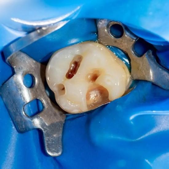 GDC Rubber Dam Clamp Adult 201 (Rdc201)