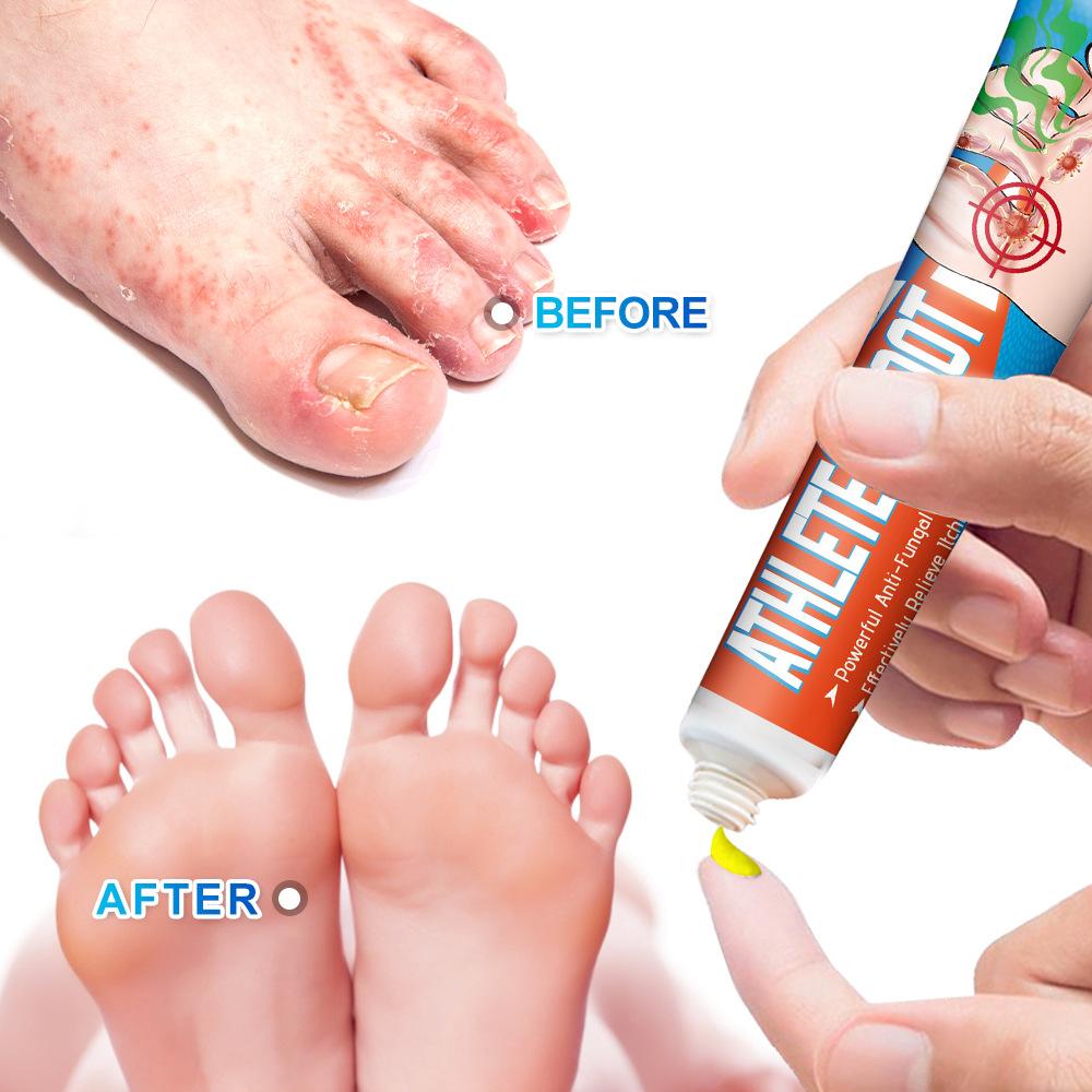 Sumifun 20/40/100 ML Fußjuckreiz Lindernde Creme Reduziert Fußgeruch Schweißbildung Schälen Löst Fußpilz Beschwerden Bakteriostatische Salbe