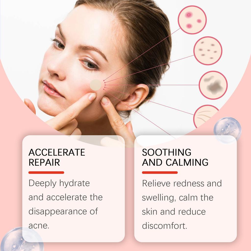 Ouhoe Acne Patches For Facial Care And Support To Reduce Blemishes And Improve Skin Appearance