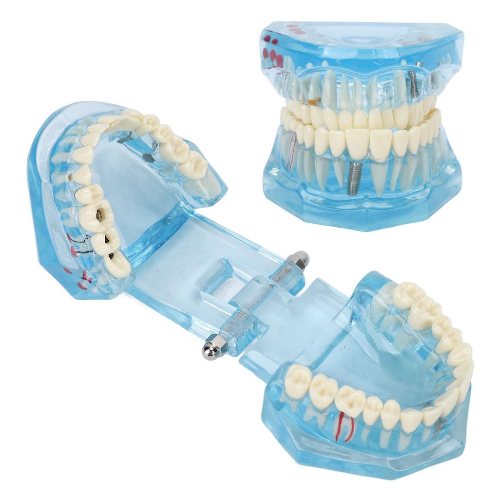 Dental Pathological Model Clear Teaching Detachable Dental Teeth Display Model Blue Transparent