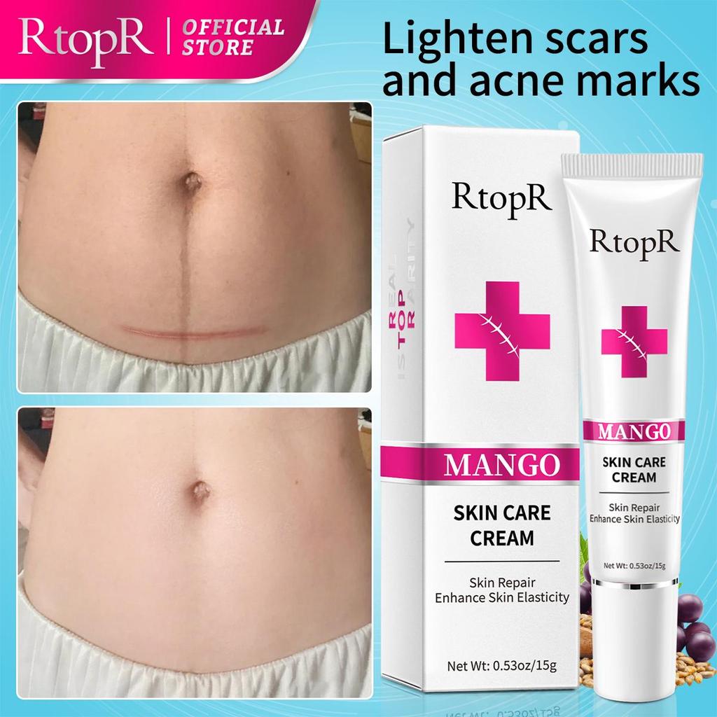 RtopR Acne Removal Cream Skin Repair Face Cream Acne Spots Acne Blackhead Whitening Cream