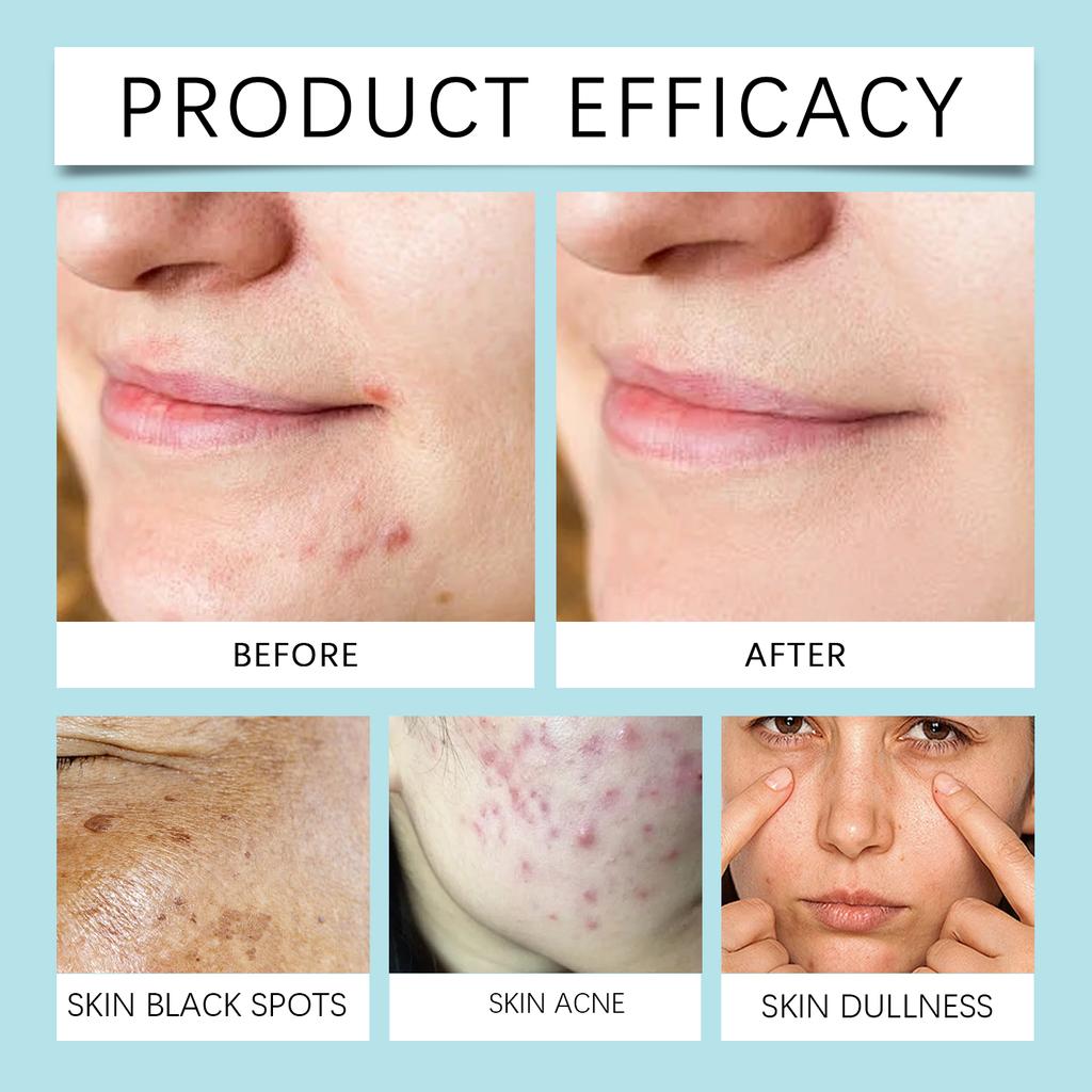 Acne Removing Scar Moisturizing Cream Acne Cream Printed Acne Pits Facial Care Acne Stability Scar Removing Acne Relief