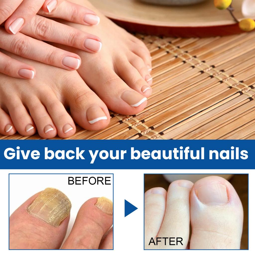 Onychomycosis Solution, Thickening Bright Onychomycosis Remover, Soft Onychomycosis, Hand And Foot Nail Care Solution 30ml