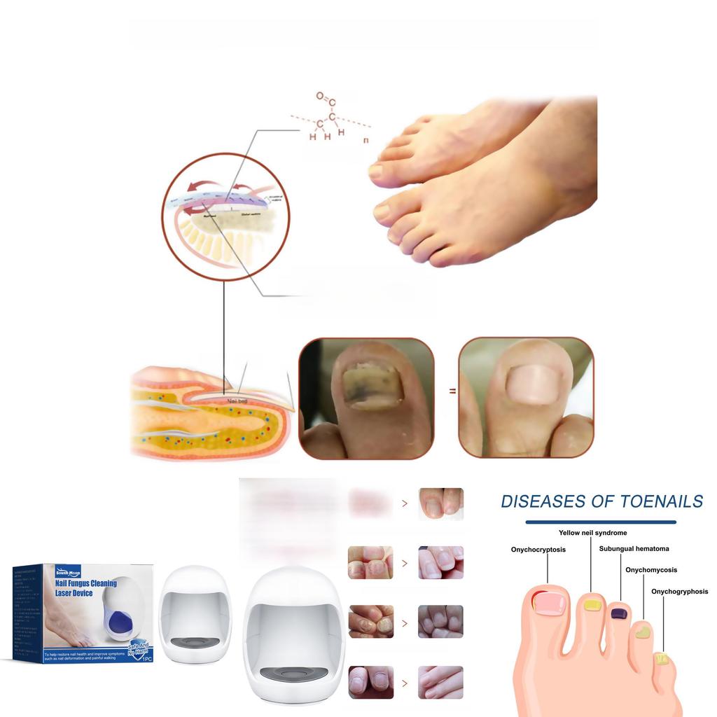 Comprehensive Nail Care Treatment South Moon Targets Yellow Nails Ingrown Nails