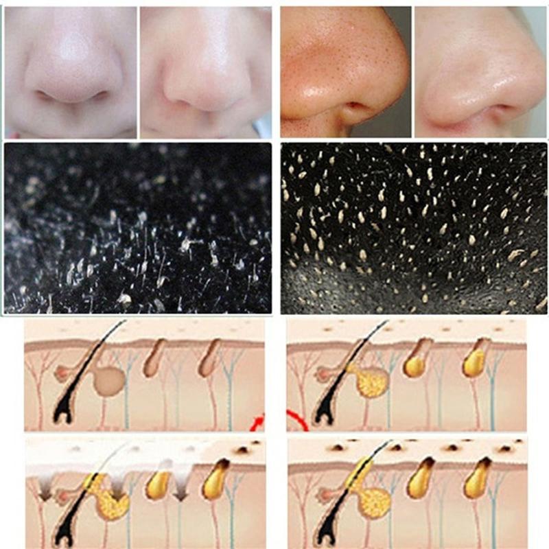 10Pcs Nose Blackhead Remover Mask Deep Cleaning Shrink Pore Acne Treatment Mask