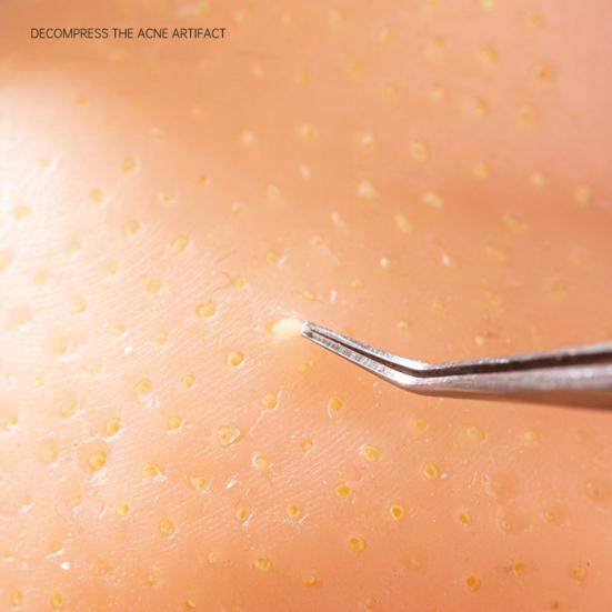 Man Hoofd Puistjes Knijpen Speelgoed met Pincet Angst Stressverlichting Acne Knijpen Reiniging Fidget Speelgoed Mee-eters Verwijdering Decompressie Sensorisch Speelgoed