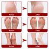 Jaysuing Fruit Acid Exfoliating Foot Mask Gently Exfoliates, Softens Calluses, Rejuvenates Skin, Moisturizes and Moisturizes Beautiful Feet