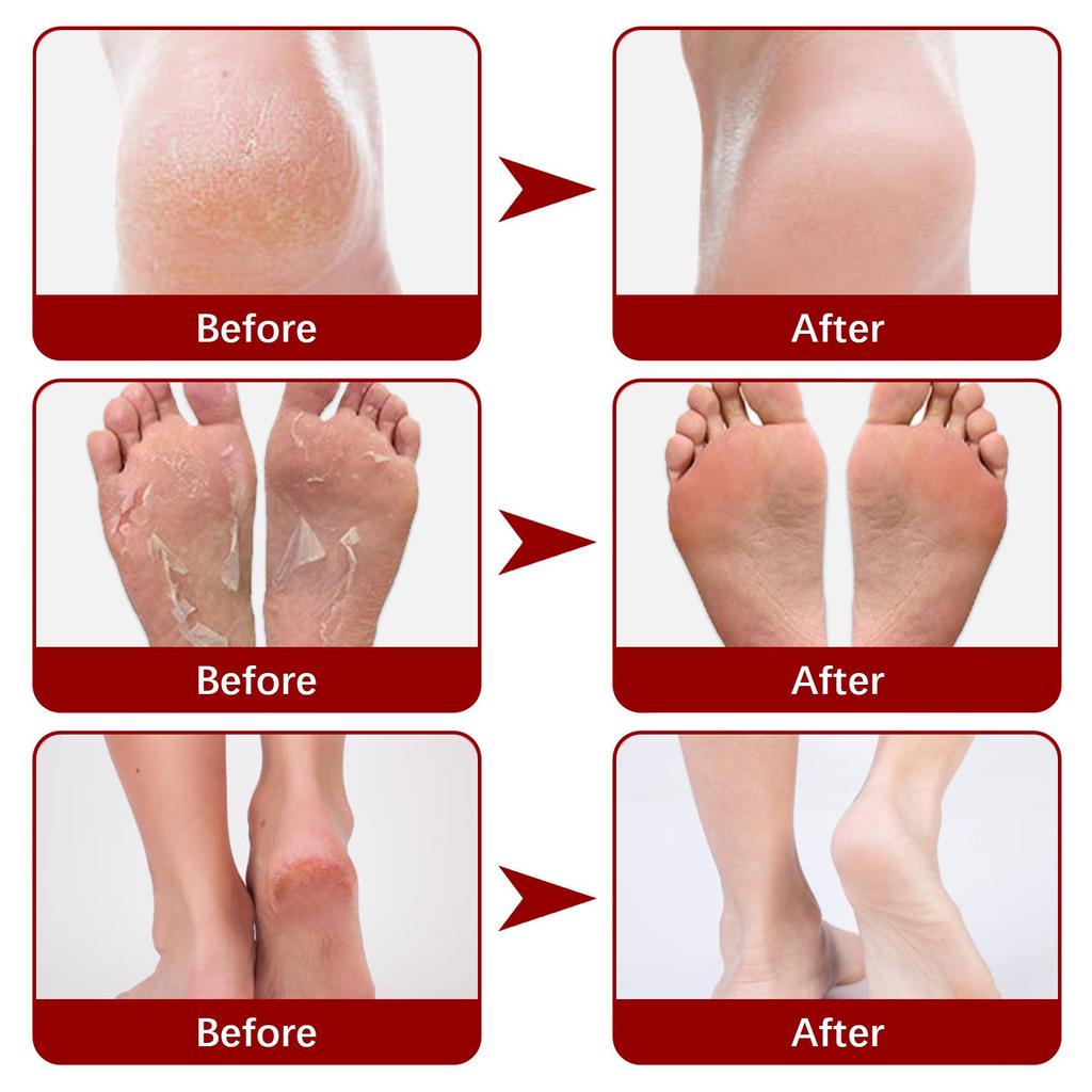 Jaysuing Fruit Acid Exfoliating Foot Mask Gently Exfoliates, Softens Calluses, Rejuvenates Skin, Moisturizes and Moisturizes Beautiful Feet